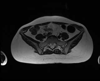 File:Bicornuate bicollis uterus (Radiopaedia 61626-69616 Axial T2 1).jpg