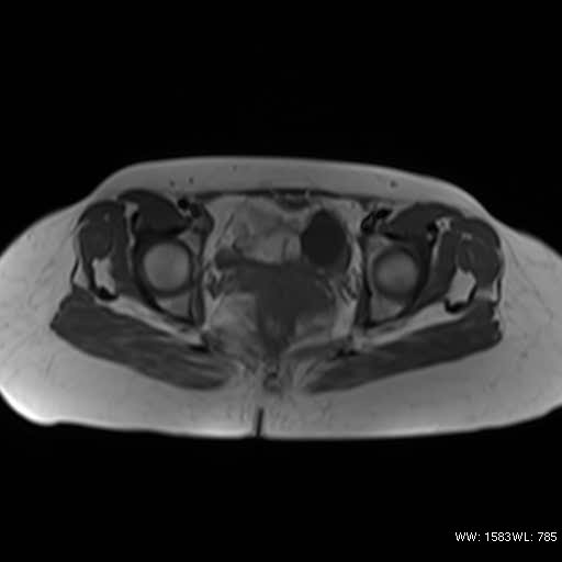 File:Bicornuate uterus (MRI) (Radiopaedia 49206-54297 Axial 3).jpg