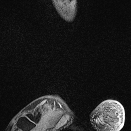 Bilateral Achilles tendon complete tear (Radiopaedia 81344-95051 Sagittal WE - Right 101).jpg