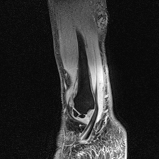 Bilateral Achilles tendon complete tear (Radiopaedia 81344-95051 Sagittal WE - Right 22).jpg