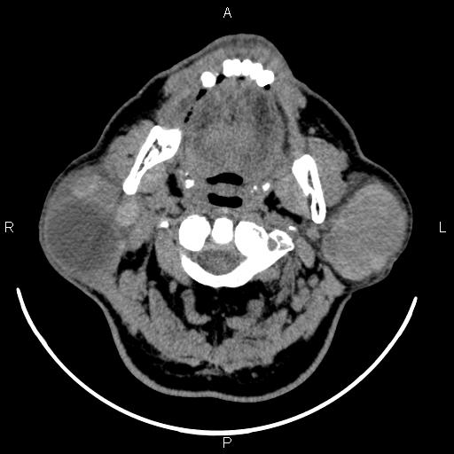Bilateral Warthin tumors (Radiopaedia 84034-99263 Axial non-contrast 20).jpg