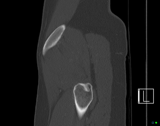 Bilateral acetabular fractures (Radiopaedia 79272-92308 Sagittal bone window 82).jpg