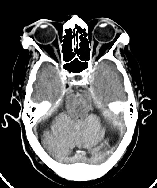 Bilateral acute on chronic subdural hematomas (Radiopaedia 78466-91146 Axial non-contrast 21).jpg