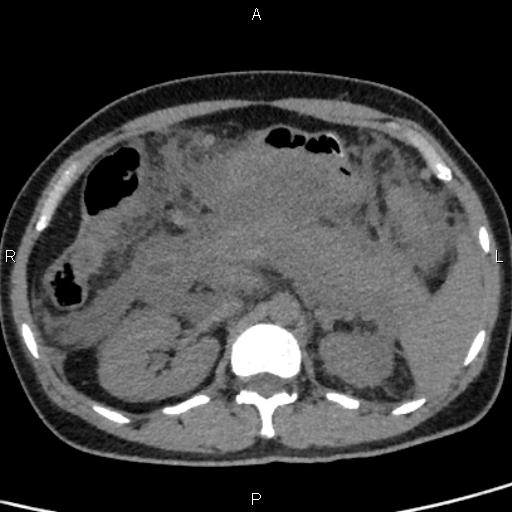 Bilateral adrenal gland hyperenhancement in pancreatitis (Radiopaedia 86642-102753 Axial non-contrast 42).jpg