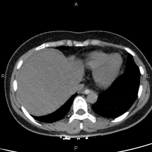 Bilateral adrenal gland hyperenhancement in pancreatitis (Radiopaedia 86642-102753 Axial non-contrast 9).jpg