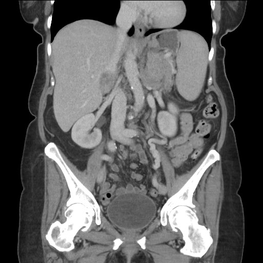 Bilateral adrenal granulocytic sarcomas (chloromas) (Radiopaedia 78375-91007 B 49).jpg