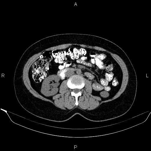 File:Bilateral adrenal myelolipoma (Radiopaedia 63058-71535 Axial non-contrast 85).jpg