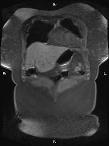 File:Bilateral adrenal myelolipoma (Radiopaedia 63058-71537 Coronal T1 fat sat 91).jpg