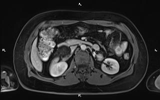 Bilateral adrenal myelolipoma (Radiopaedia 63058-71537 G 48).jpg