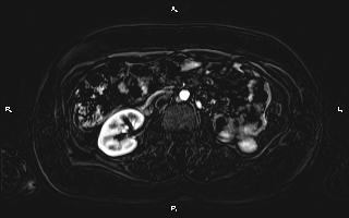 Bilateral adrenal myelolipoma (Radiopaedia 63058-71537 I 56).jpg