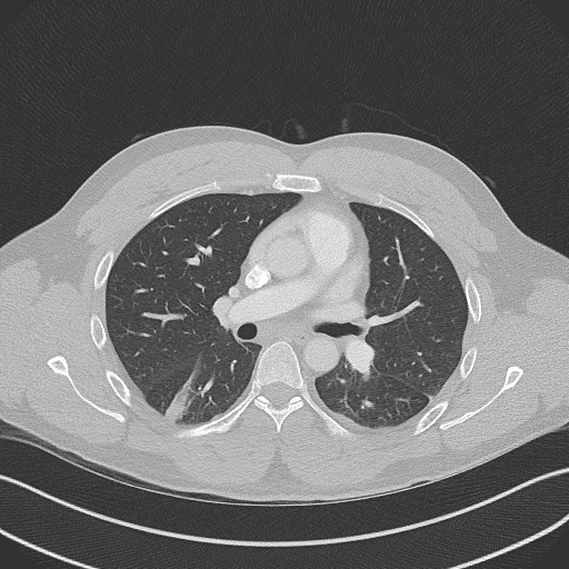Bilateral atelectasis (Radiopaedia 48666-53675 Axial lung window 52).jpg