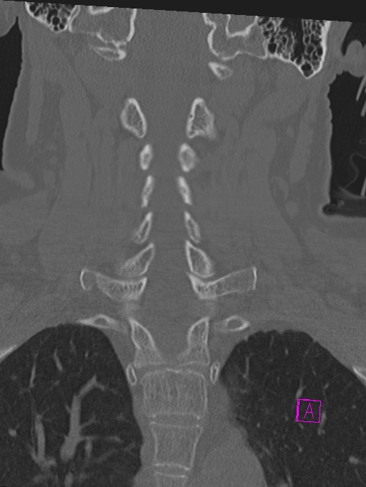 Bilateral atlanto-occipital assimilation (Radiopaedia 28350-28603 Coronal bone window 25).jpg