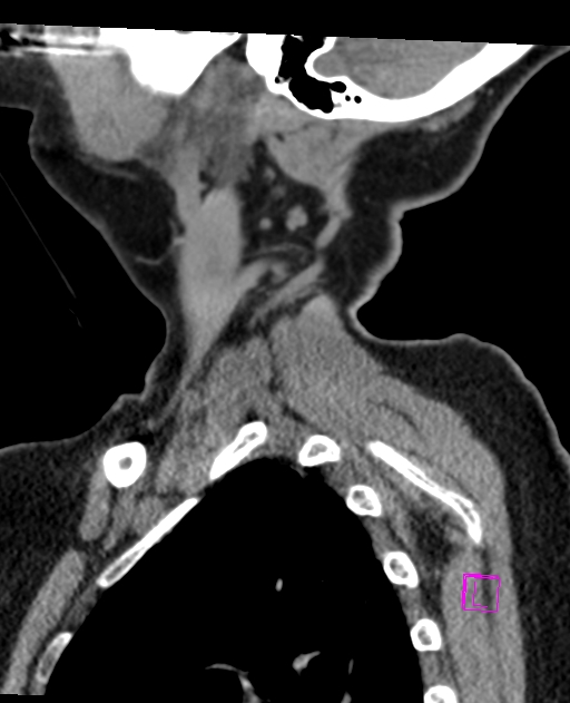 Bilateral atlanto-occipital assimilation (Radiopaedia 28350-28603 D 8).jpg