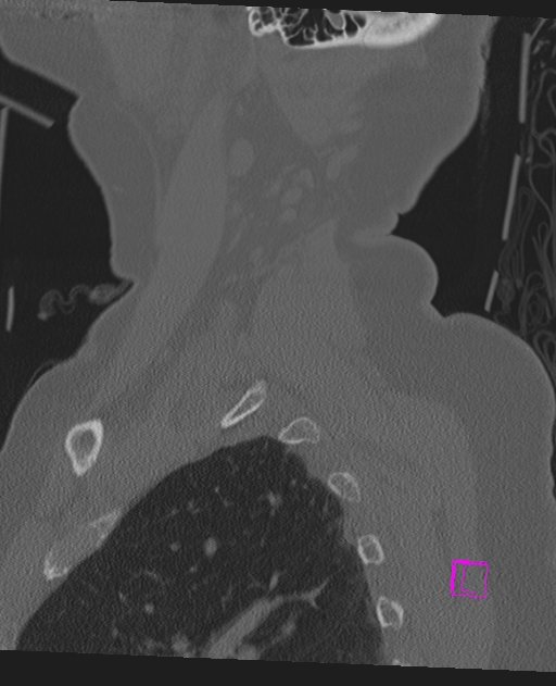 Bilateral atlanto-occipital assimilation (Radiopaedia 28350-28603 Sagittal bone window 70).jpg