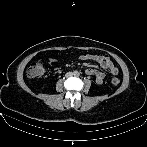 Bilateral benign adrenal adenomas (Radiopaedia 86912-103124 Axial C+ delayed 88).jpg