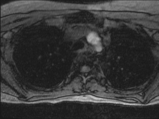 Bilateral carotid body tumors and right glomus jugulare tumor (Radiopaedia 20024-20060 Axial MRA 156).jpg
