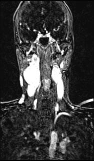 Bilateral carotid body tumors and right glomus jugulare tumor (Radiopaedia 20024-20060 MRA 100).jpg