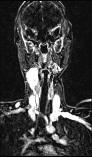 Bilateral carotid body tumors and right glomus jugulare tumor (Radiopaedia 20024-20060 MRA 89).jpg