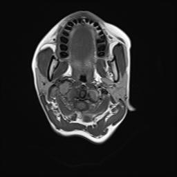 File:Bilateral carotid body tumors and right jugular paraganglioma (Radiopaedia 20024-20060 Axial 13).jpg