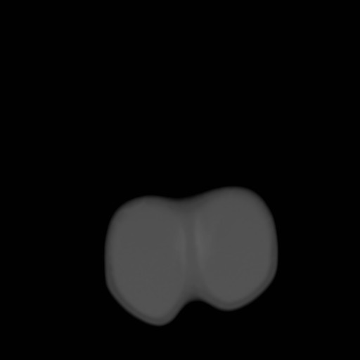 File:Bilateral cephalohematomas and subdural hematomas (Radiopaedia 26778-26929 Axial bone window 32).jpg