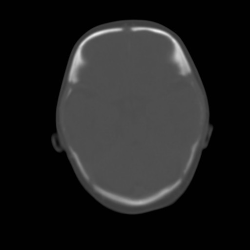 File:Bilateral cephalohematomas and subdural hematomas (Radiopaedia 26778-26929 Axial bone window 6).jpg