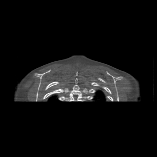 File:Bilateral chronic posterior shoulder dislocation (Radiopaedia 39213-41452 Coronal bone window 56).jpg