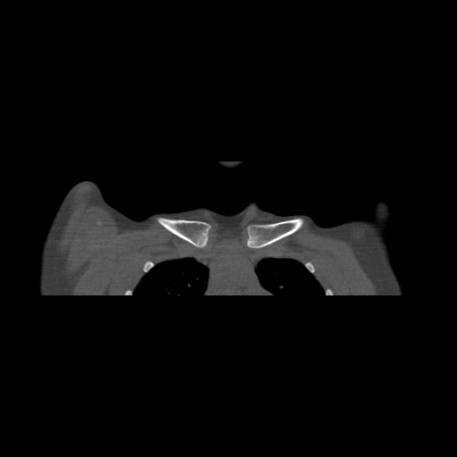 Bilateral chronic posterior shoulder dislocation (Radiopaedia 39213-41452 Coronal bone window 7).jpg