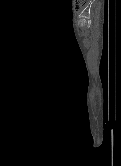 Bilateral fibular hemimelia type II (Radiopaedia 69581-79491 Sagittal bone window 32).jpg