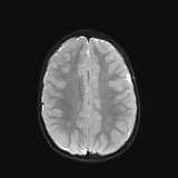 File:Bilateral mesial temporal polymicrogyria (Radiopaedia 76456-88181 Axial DWI 18).jpg