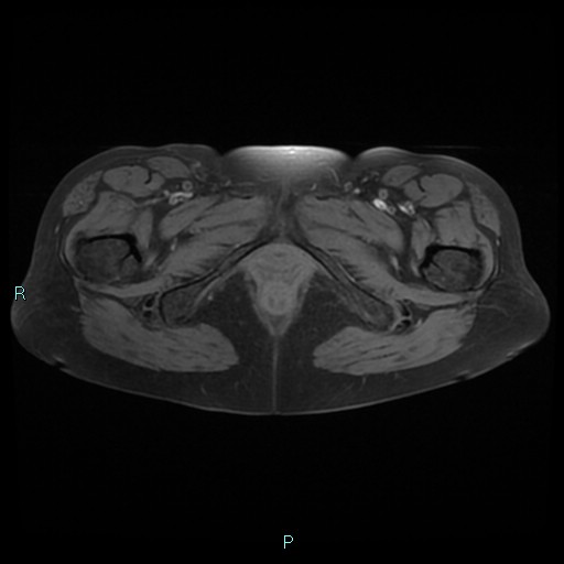 File:Bilateral ovarian fibroma (Radiopaedia 44568-48293 Axial T1 fat sat 29).jpg