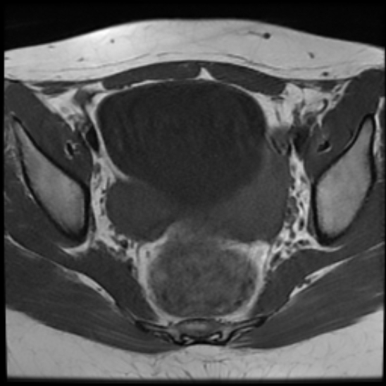 File:Bilateral ovarian fibrothecomas - adolescent (Radiopaedia 86604-102707 Axial T1 17).jpg