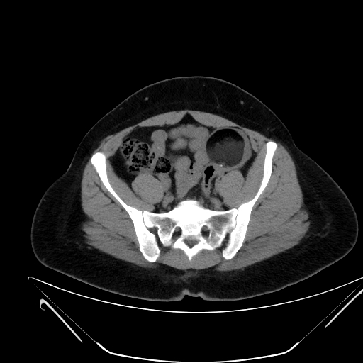 File:Bilateral ovarian mature cystic teratomas (Radiopaedia 79373-92457 Axial non-contrast 51).jpg