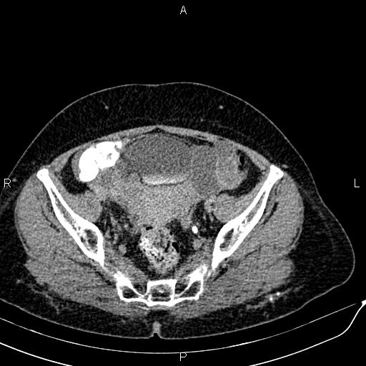 Bilateral ovarian serous cystadenocarcinoma (Radiopaedia 86062-101989 Axial C+ delayed 65).jpg