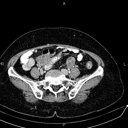 Bilateral ovarian serous cystadenocarcinoma (Radiopaedia 86062-101989 B 74).jpg