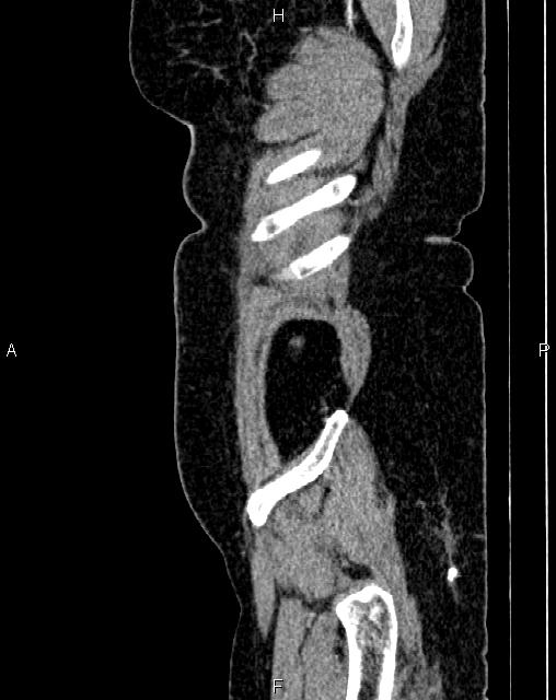 Bilateral ovarian serous cystadenocarcinoma (Radiopaedia 86062-101989 E 3).jpg