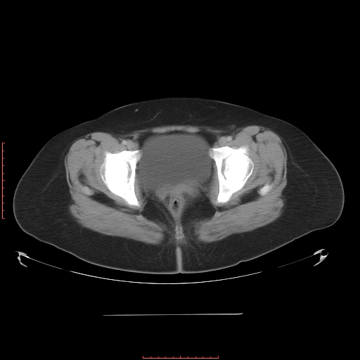 File:Bilateral ovarian serous cystadenocarcinoma with right ovarian torsion (Radiopaedia 32640-33611 A 41).jpg