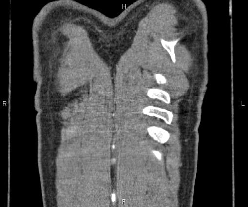 Bilateral pulmonary AVM (Radiopaedia 83134-97505 C 74).jpg