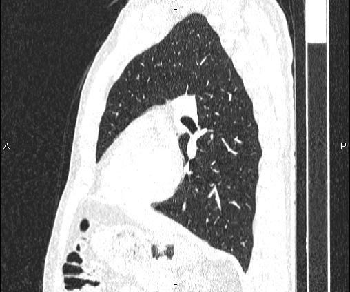 File:Bilateral pulmonary AVM (Radiopaedia 83134-97505 Sagittal lung window 73).jpg