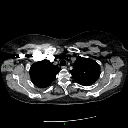 Bilateral pulmonary emboli (Radiopaedia 32700-33669 Axial C+ CTPA 16).jpg