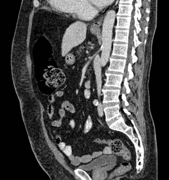 Bilateral rectus sheath hematomas (Radiopaedia 50778-56252 B 44).jpg