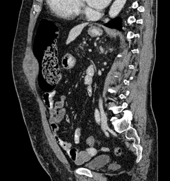 File:Bilateral rectus sheath hematomas (Radiopaedia 50778-56252 B 48).jpg
