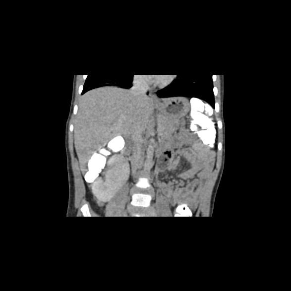 File:Bilateral renal malrotation (Radiopaedia 30901-31606 B 27).jpg
