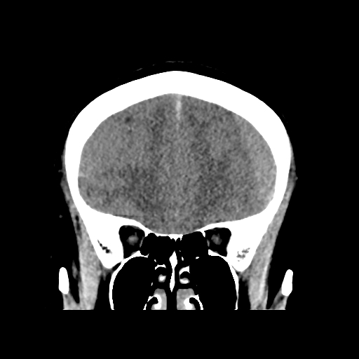 Bilateral subacute subdural hematoma (Radiopaedia 69240-79018 Coronal non-contrast 15).jpg