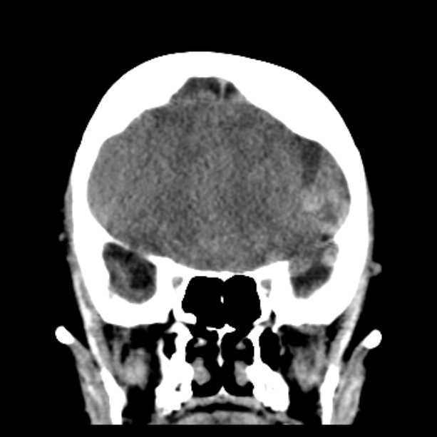 Bilateral subdural hemorrhages (Radiopaedia 26588-26732 Coronal non-contrast 20).jpg