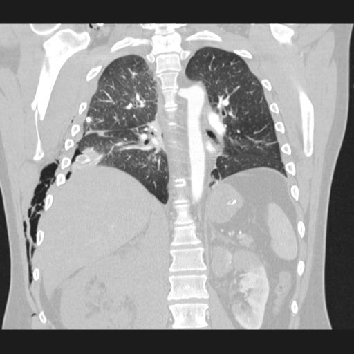 Bilateral traumatic renovascular injury (Radiopaedia 32051-32995 Coronal lung window 52).jpg