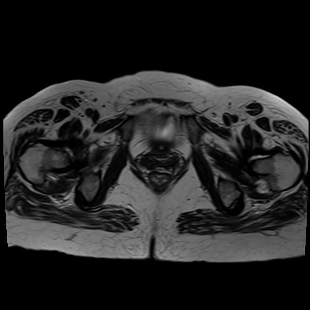 Bilateral tubo-ovarian abscesses (Radiopaedia 58635-65829 Axial T2 40).jpg