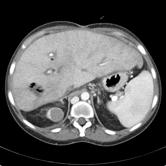 Biliary necrosis - liver transplant (Radiopaedia 21876-21846 B 18).jpg