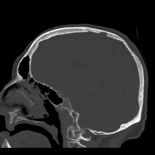 Biparietal osteodystrophy (Radiopaedia 46109-50463 Sagittal bone window 62).jpg