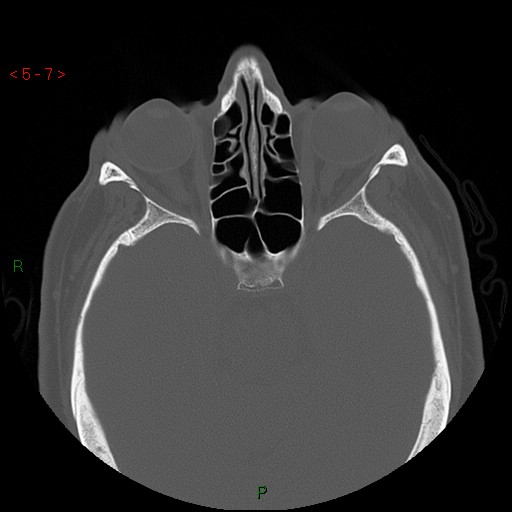 File:Bisphosphonate-related osteonecrosis of the jaw (Radiopaedia 54147-60329 Axial bone window 1).jpg