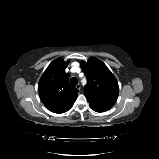 File:Bladder tumor detected on trauma CT (Radiopaedia 51809-57609 A 29).jpg